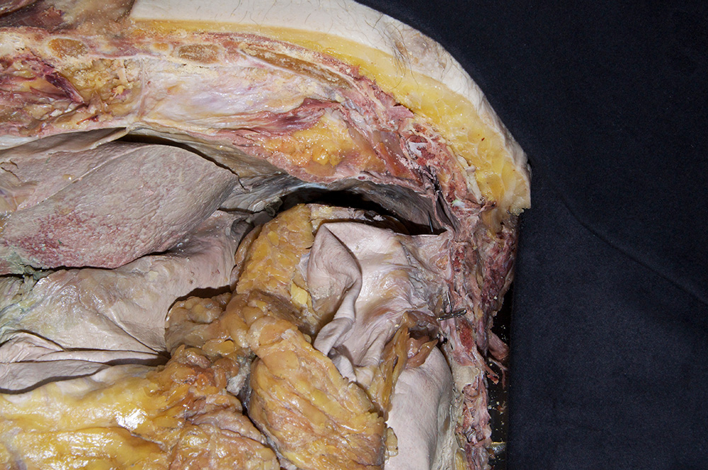 Phrenicocolic Ligament