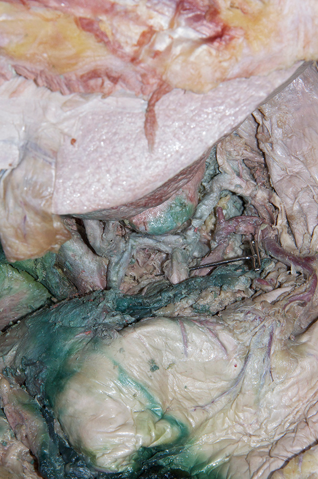 Splenic Artery