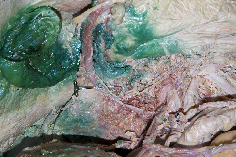 Superior Pancreaticoduodenal Artery