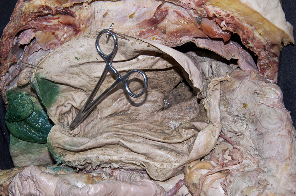 Pyloric Orifice