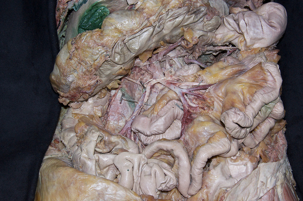 Superior Mesenteric Vein