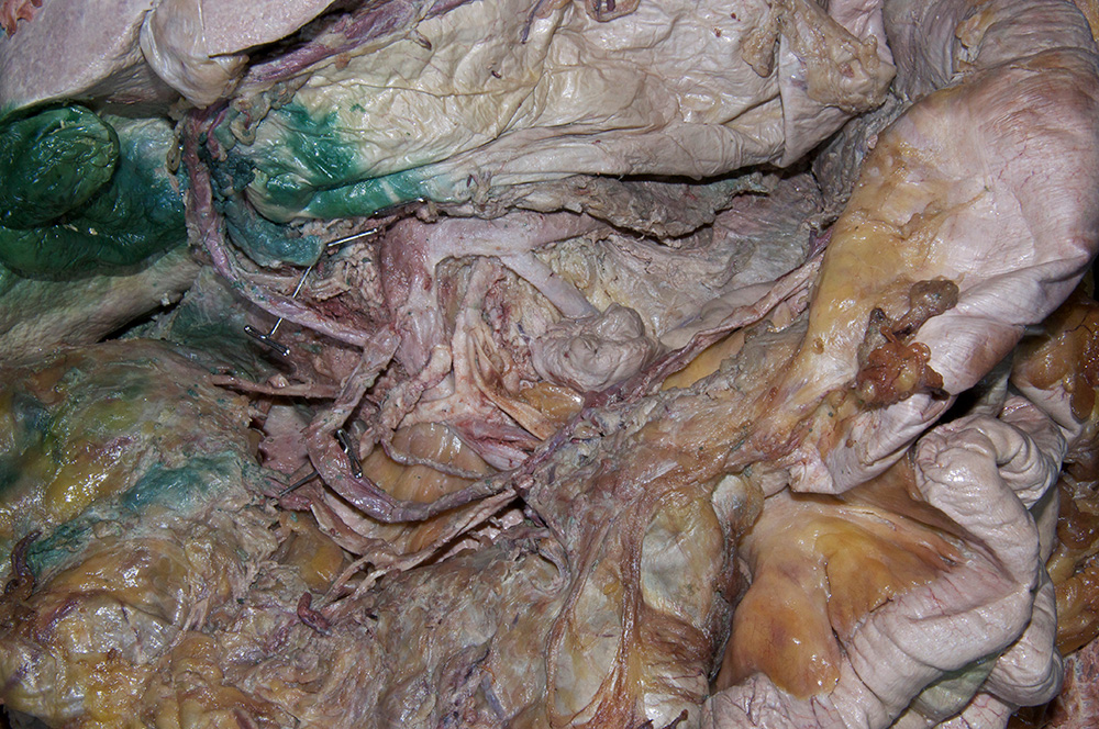 Hepatic Portal Vein