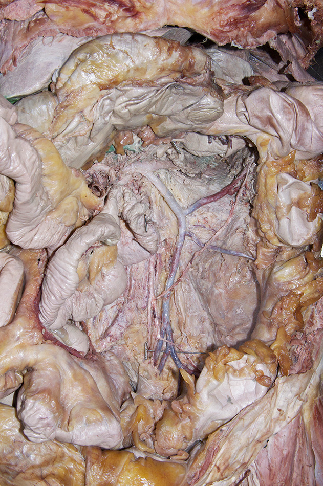 Inferior Mesenteric Vein