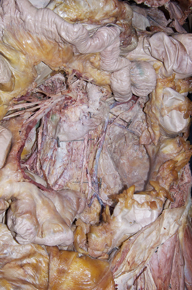 Inferior Mesenteric Artery