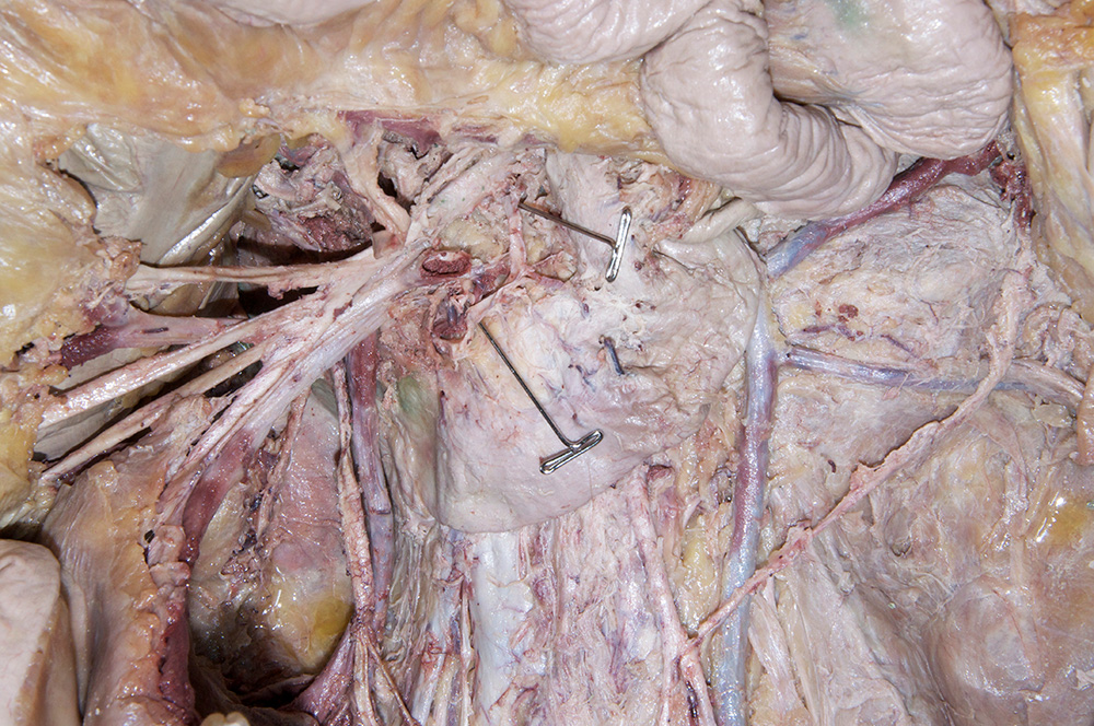 Inferior Pancreaticoduodenal Artery