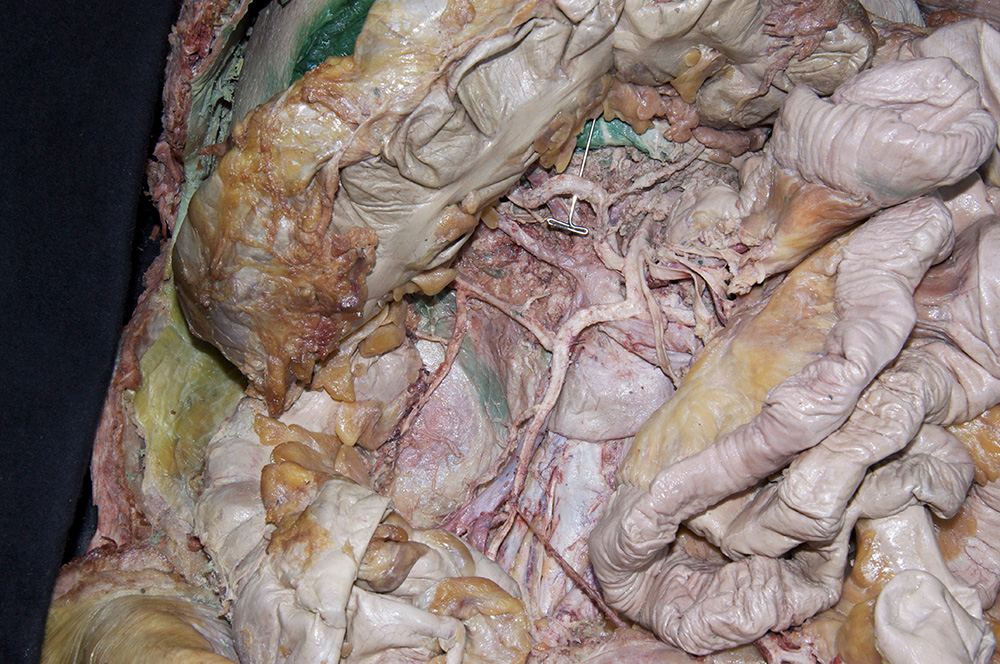 Middle Colic Artery