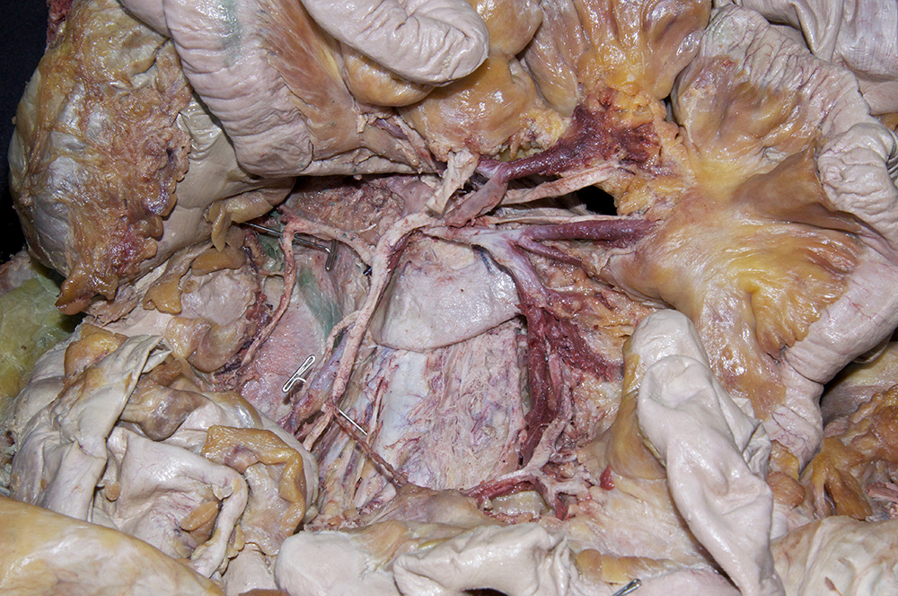Right Colic Artery