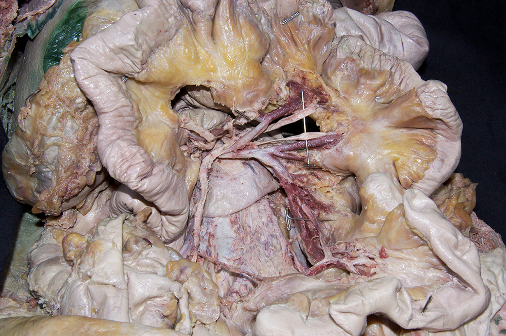 Jejunal and Ileal Arteries