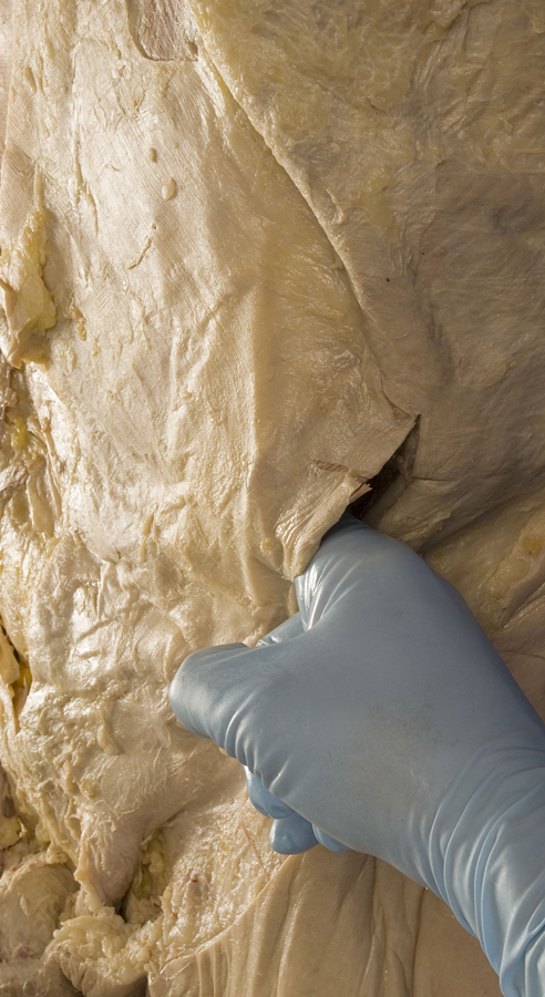Opening the Anterior Abdominal Wall