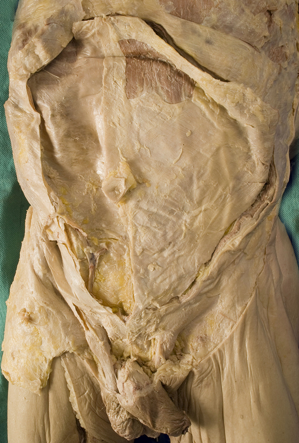 Anterior Abdominal Wall (incision lines)