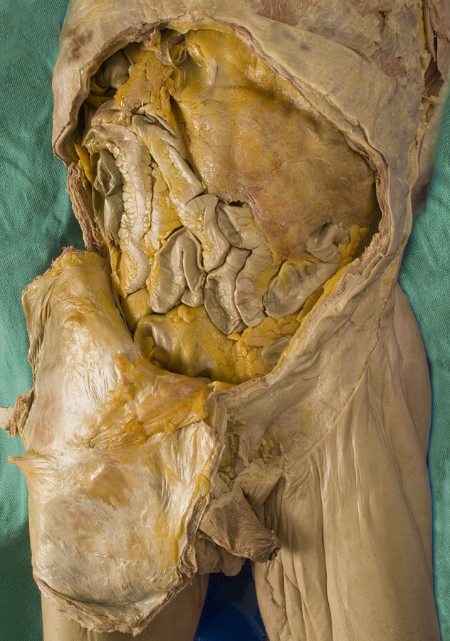 Anterior Abdominal Wall (reflected)