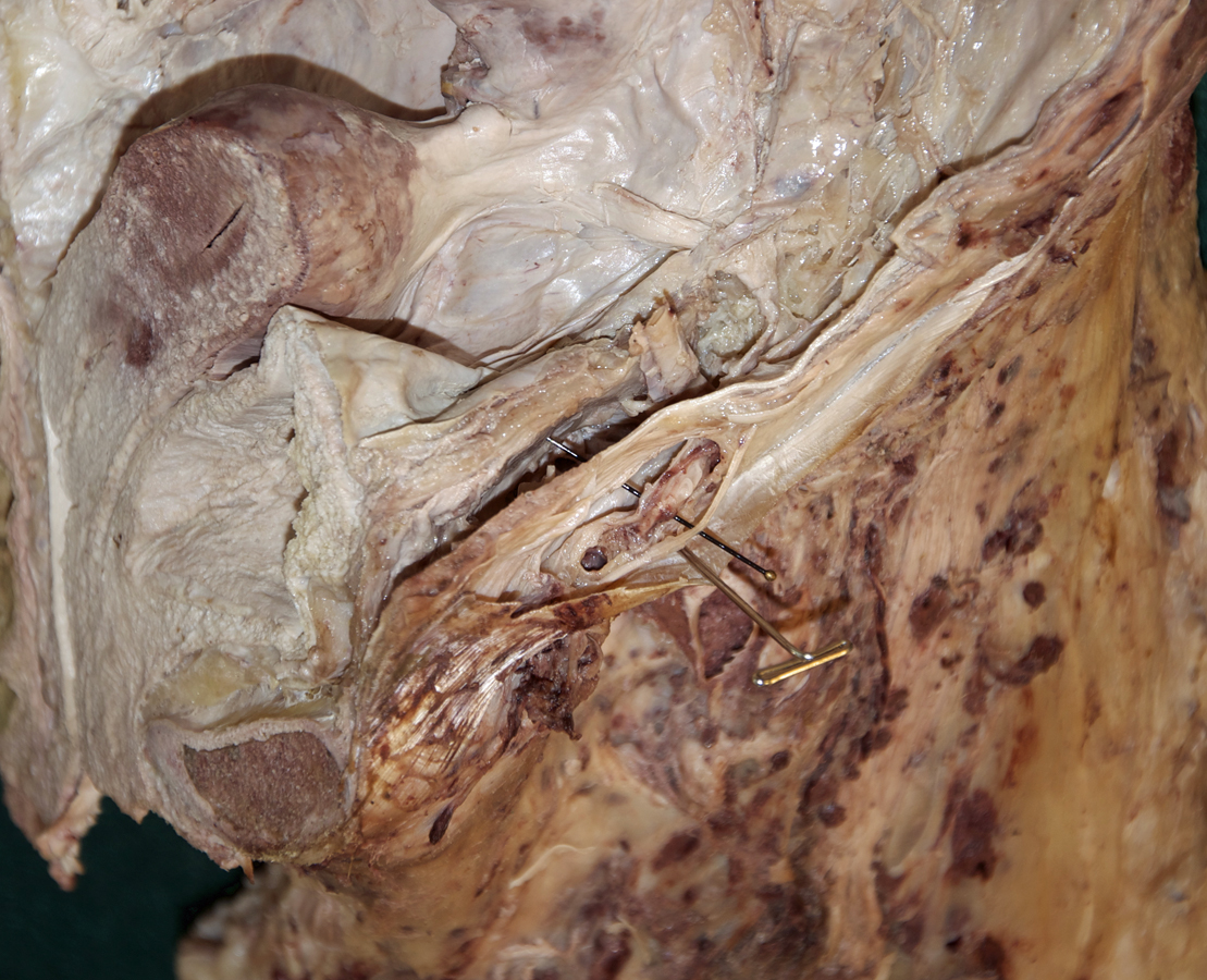 Female Left Inguinal Canal (hemisected pelvis)