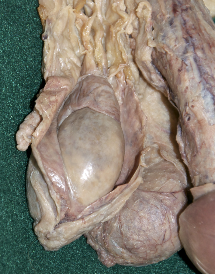 Tunica Vaginalis