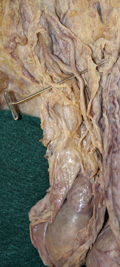 Right Ductus Deferens
