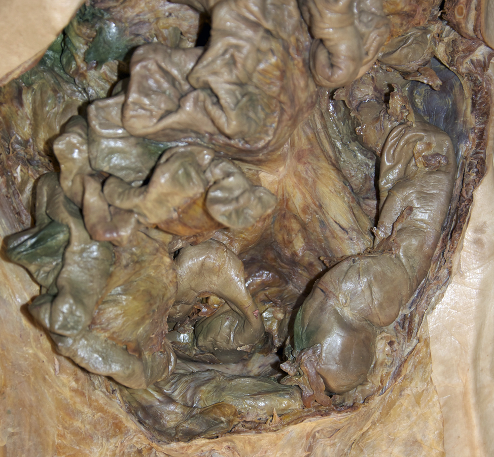 Sigmoid Colon