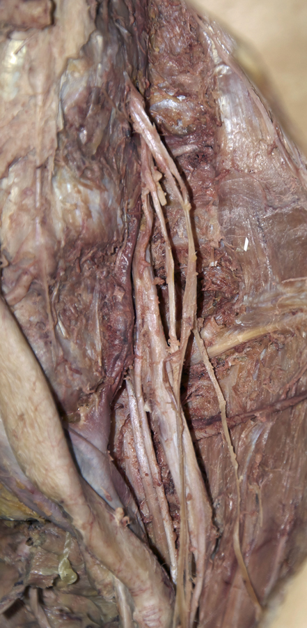 Lumbar Plexus (psoas muscle removed)