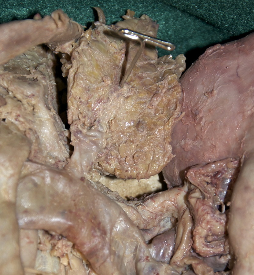Left Suprarenal Gland