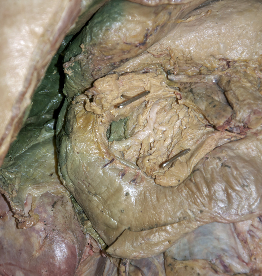Main Pancreatic Duct