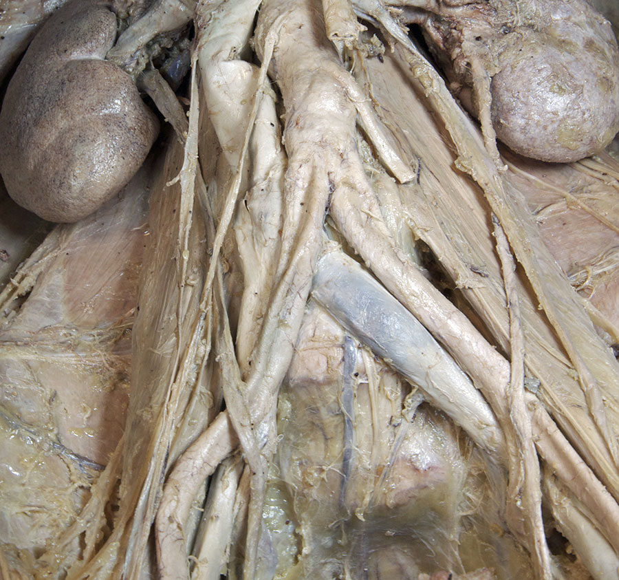 Origin of the Right Common Iliac Artery