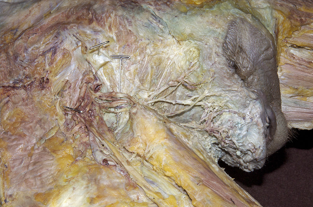 Left Pudendal Nerve
