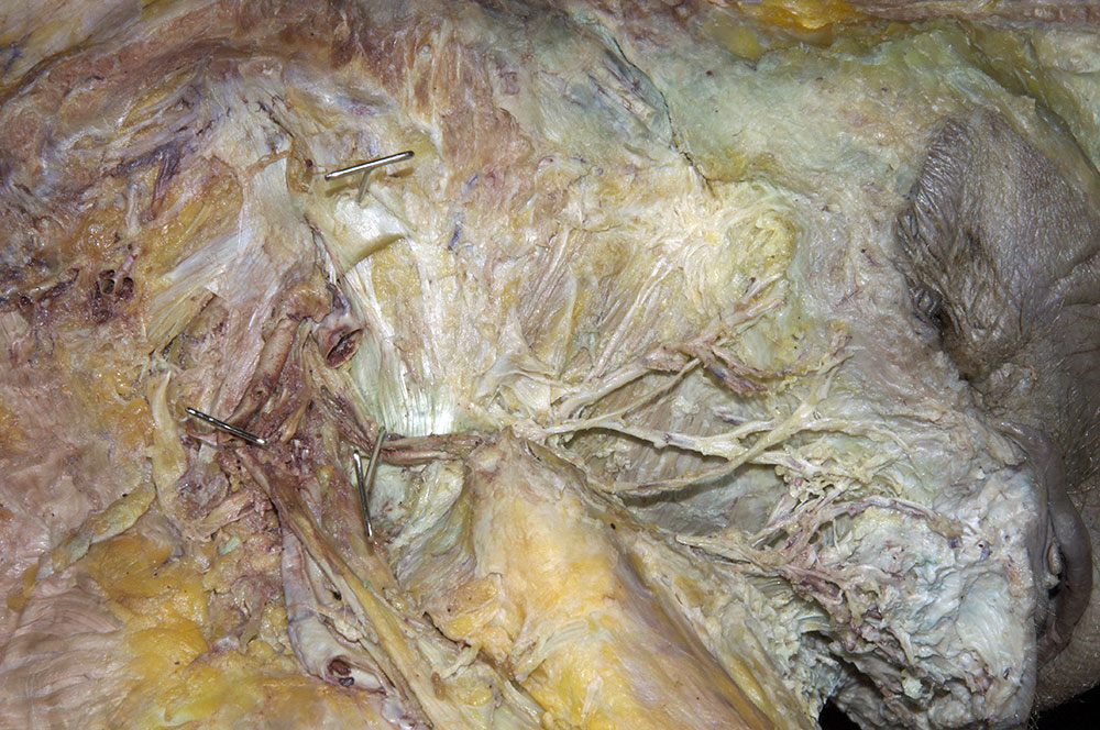 Sacrospinous Ligament