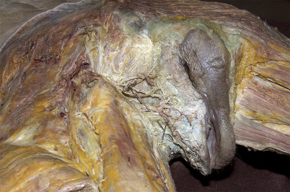 Superficial Transverse Perineus Muscle