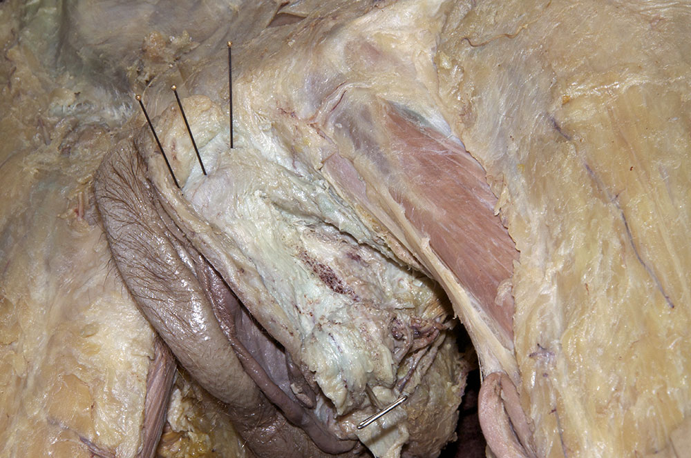Bulb of Vestibule