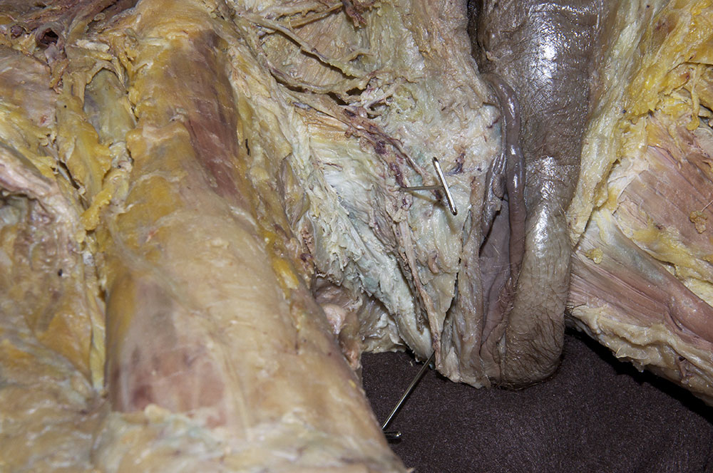 Perineal Membrane and Body
