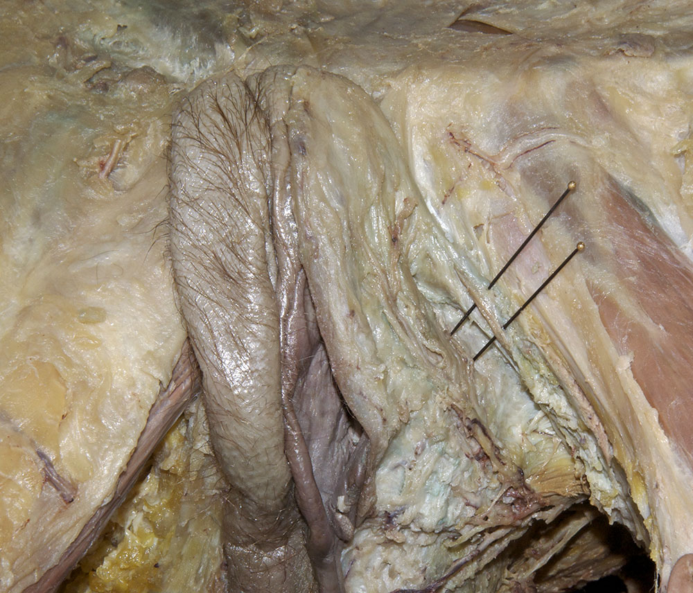 Ischiocavernosus Muscle