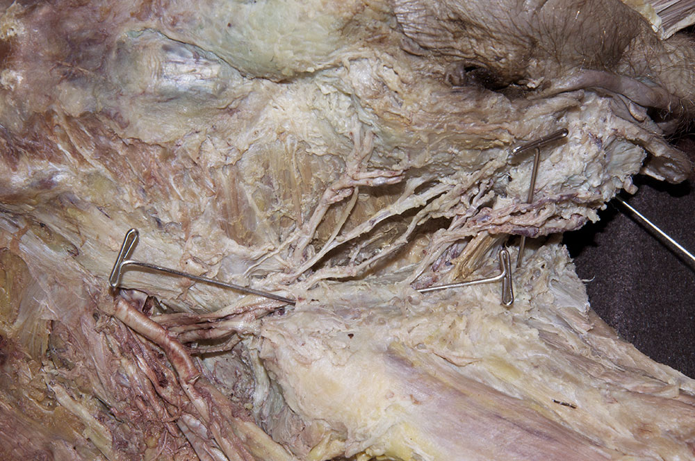 Pudendal Canal