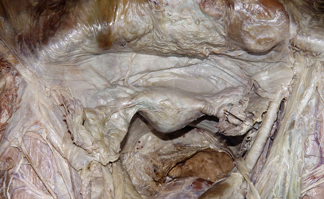 Uterine Tube