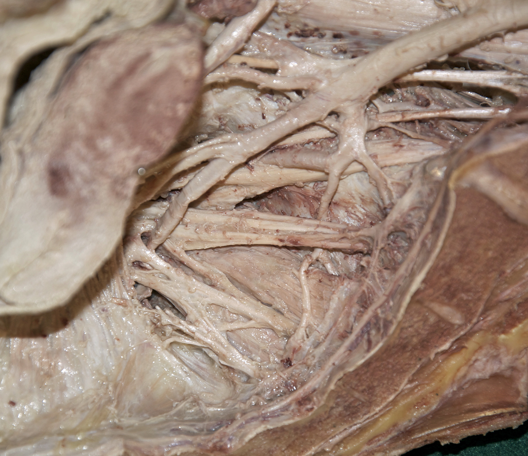 Piriformis Muscle (inferior to the left; right hemisected pelvis)