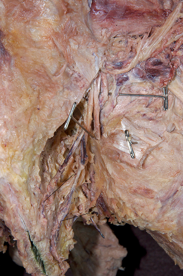 Pudendal Nerve Entering the Pudendal Canal