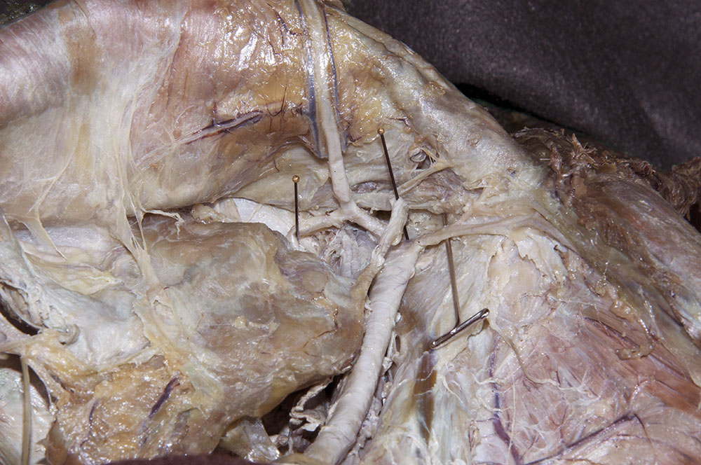 Deep Circumflex Iliac Artery