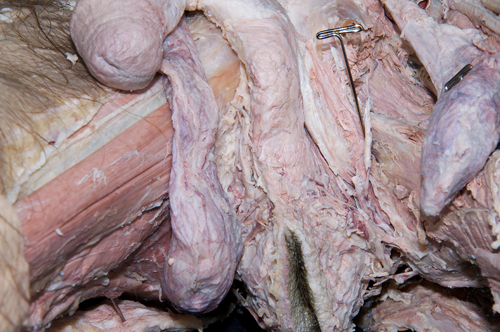 Left Crus of Penis