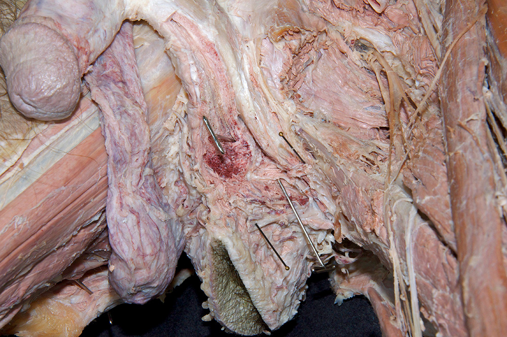 Deep Transverse Perineal Muscle