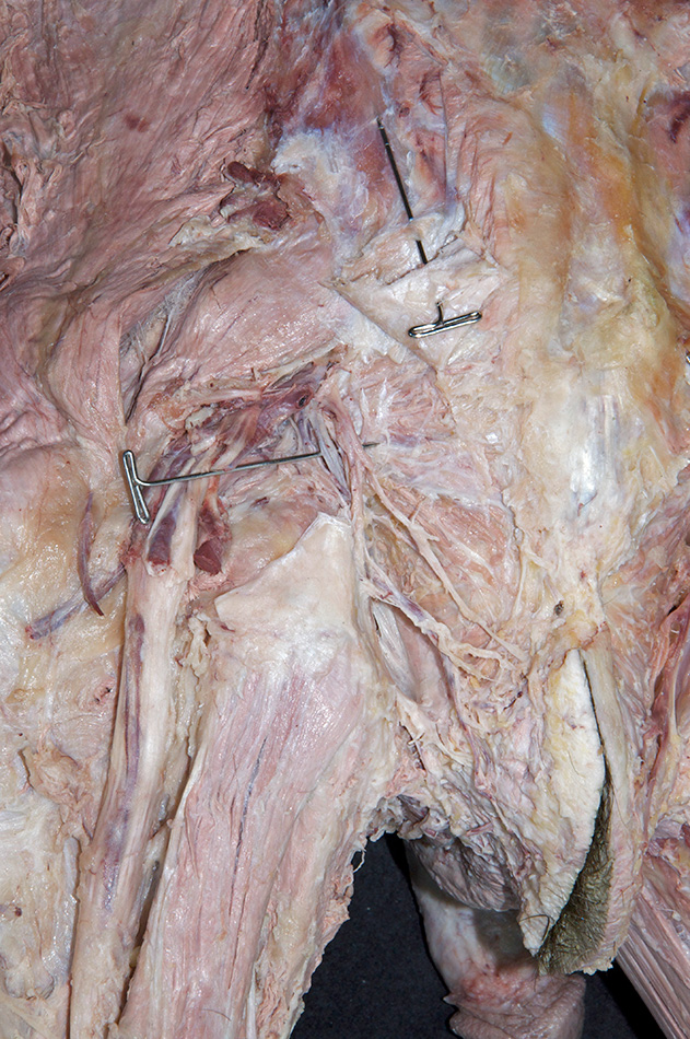 Left Pudendal Nerve