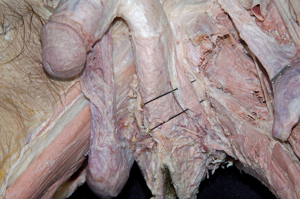 Ischiocavernosus Muscle