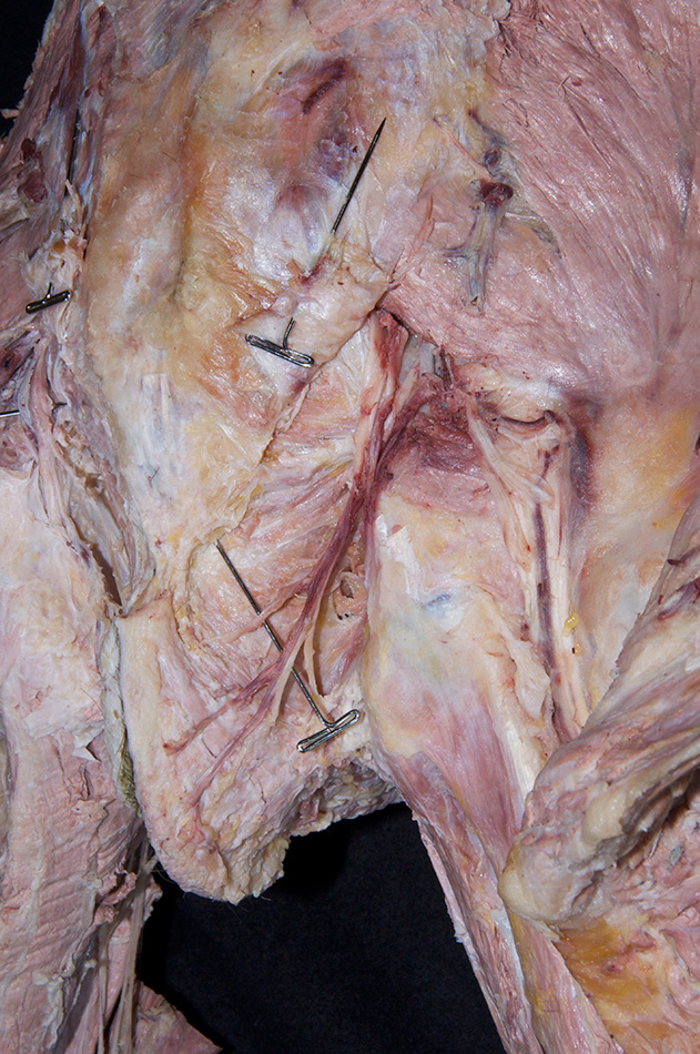 Right Inferior Rectal Nerve and Vessels