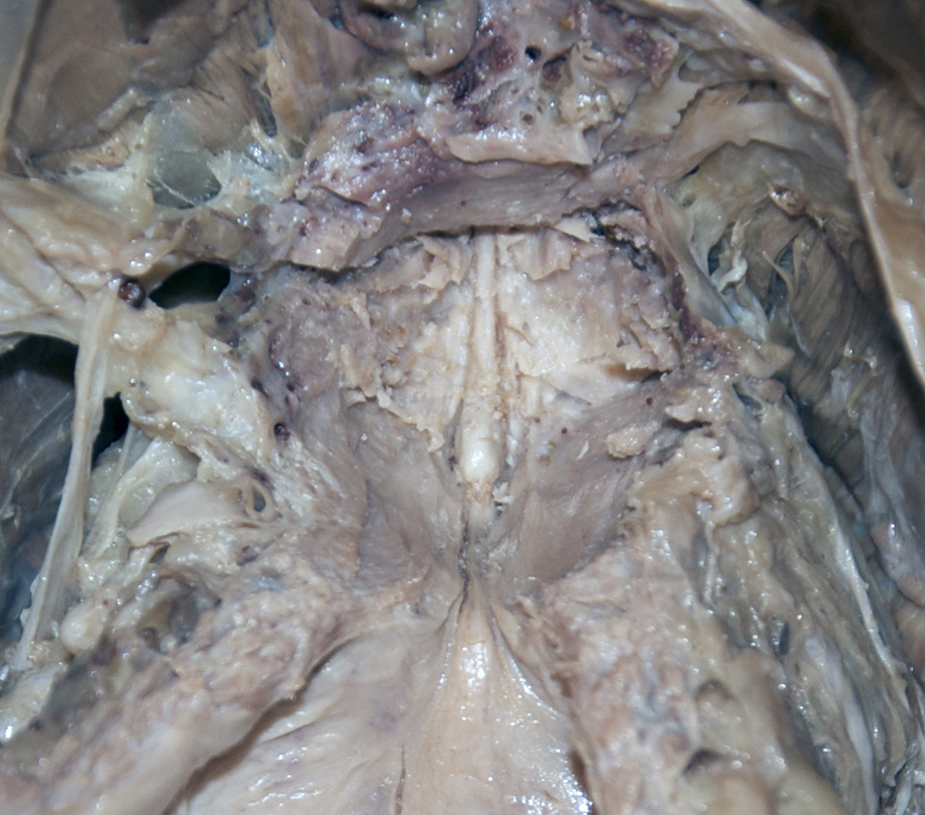 Prostatic Urethra (opened; with bladder opened and reflected posteriorly)