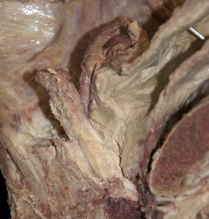 Ejaculatory Duct in Prostate (left hemisected pelvis; posterior to the left)