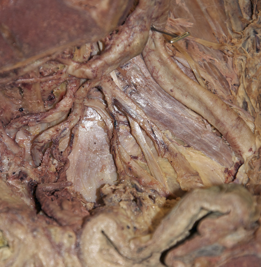 Obturator Artery (hemisected pelvis; anterior to the right)