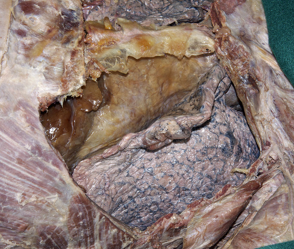 Mediastinal Pleura