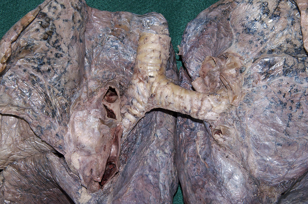 Primary Bronchi