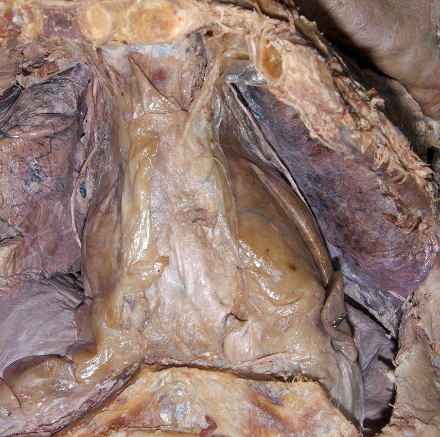 Right and Left Phrenic Nerves