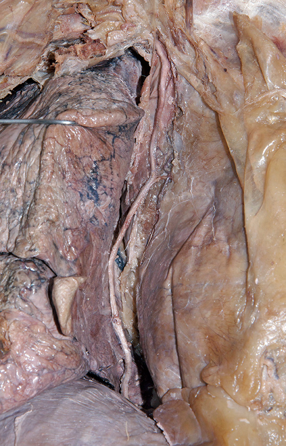 Right Phrenic Nerve