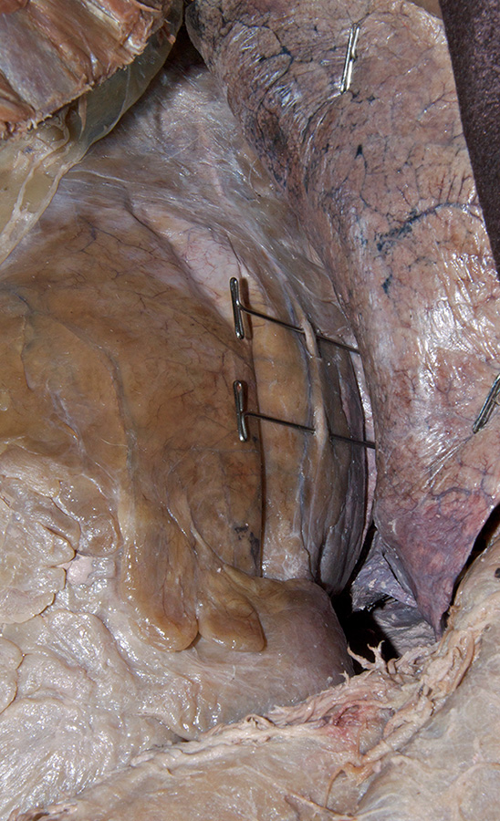 Phrenic Nerve Deep to Mediastinal Pleura