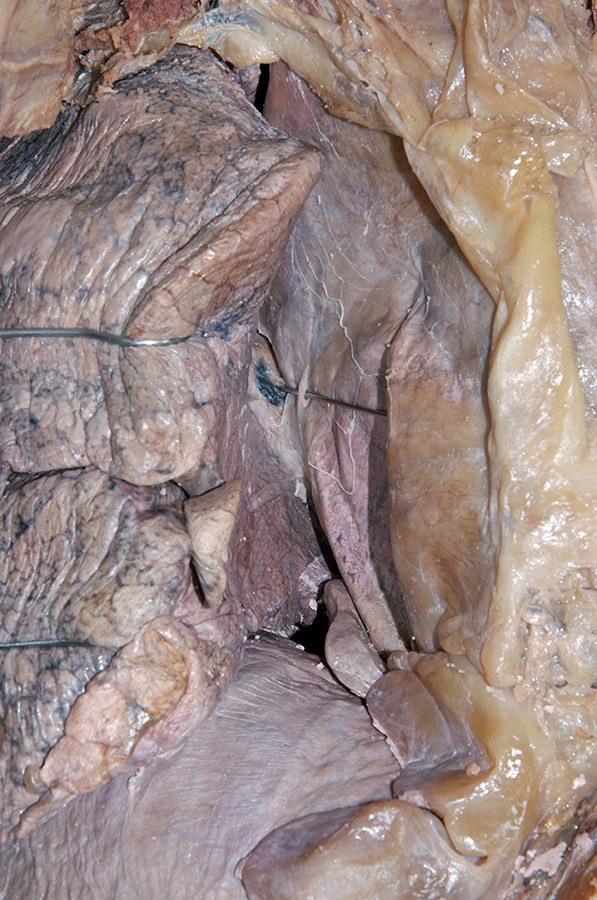 Right Phrenic Nerve Deep to Mediastinal Pleura