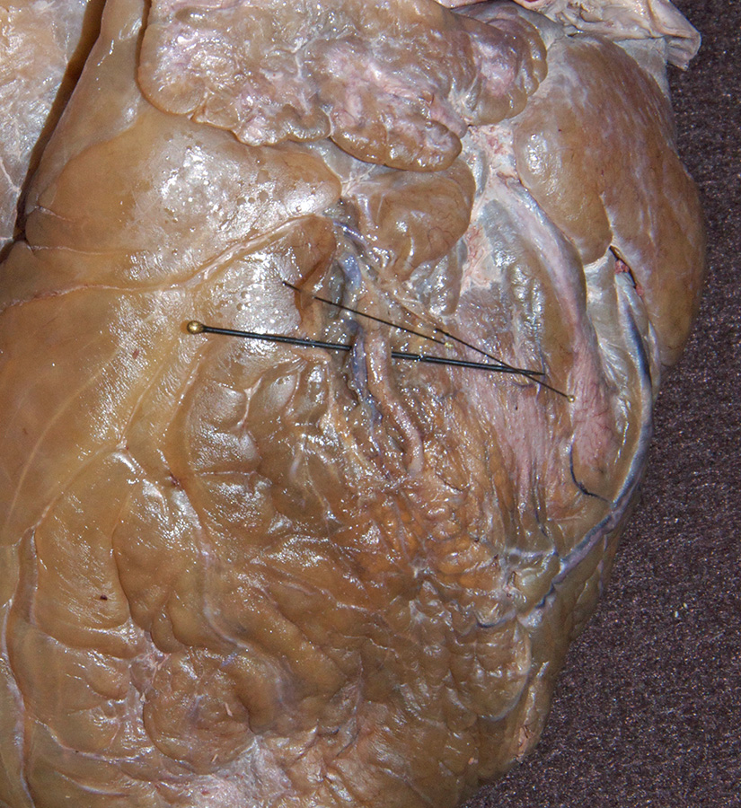 Exposing the Coronary Vessels