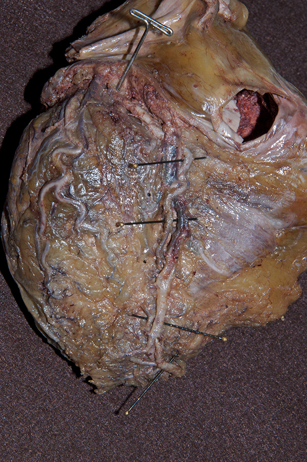 Left Coronary Artery Dominance